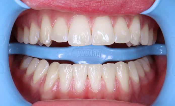 Dentadura después del tratamiento